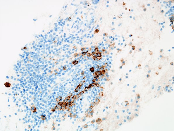 9F3 LCH (Gaegel's Granuloma) (Case 9) CD138