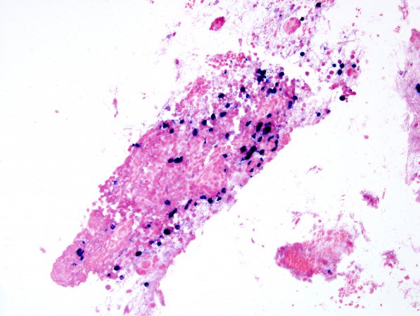 9G2 LCH (Gaegel's Granuloma) (Case 9) ISH Lambda