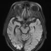 1A1 Lymphoma (Case 1) TIRM