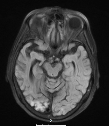 1A1 Lymphoma (Case 1) TIRM