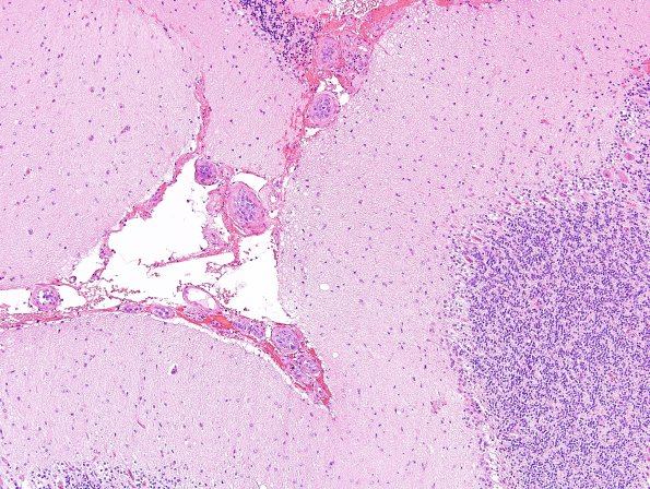 1B1 Lymphoma, intravascular (Case 1) H&E 10.jpg