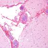 1B2 Lymphoma, intravascular (Case 1) H&E 11.jpg