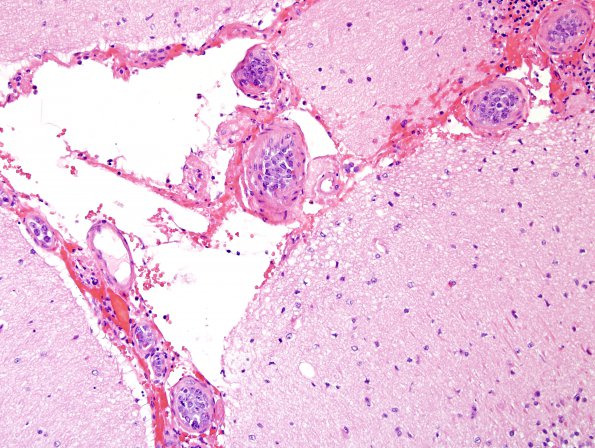 1B2 Lymphoma, intravascular (Case 1) H&E 11.jpg