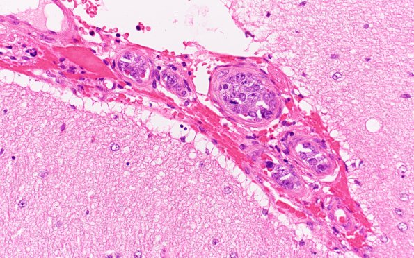 1B3 Lymphoma, intravascular (Case 1) H&E 40X