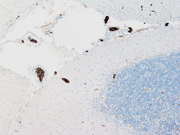 1C1 Lymphoma, intravascular (Case 1) CD20 8.jpg