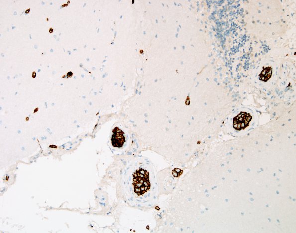 1C2 Lymphoma, intravascular (Case 1) CD20 1.jpg