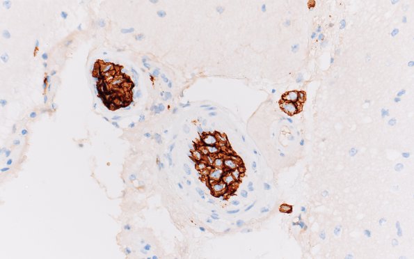 1C3 Lymphoma, intravascular (Case 1) CD20 40X