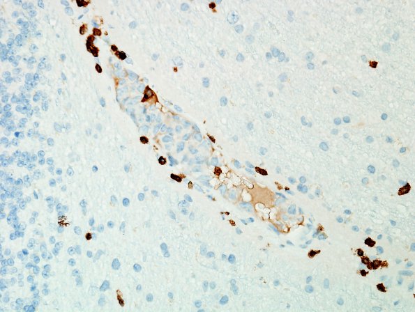 1D Lymphoma, intravascular (Case 1) CD3 2.jpg