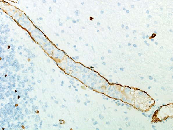 1E2 Lymphoma, intravascular (Case 1) CD34 9.jpg