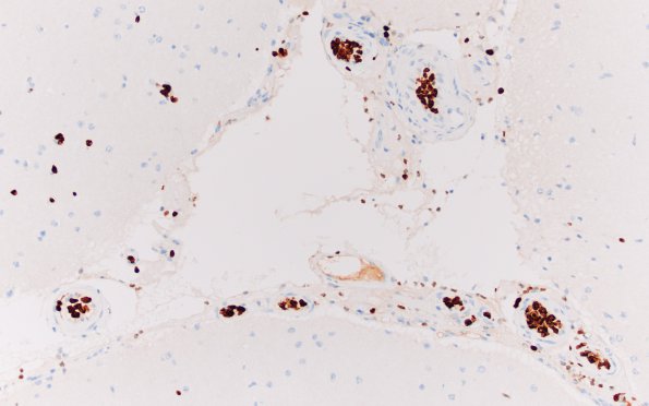 1F1 Lymphoma, intravascular (Case 1) Ki67 20x