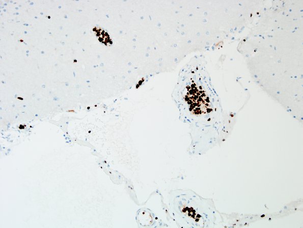 1F2 Lymphoma, intravascular (Case 1) Ki67 3.jpg