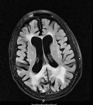 2A1 (Case 1 -5 years later) FLAIR