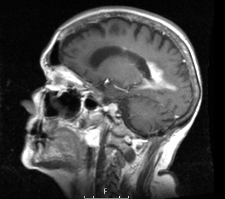 2A4 (Case 1 -5 years later)  T1 Post