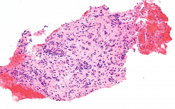 2B1 Lymphoma, B cell (Case 1 -5 years later) area A H&E 20X