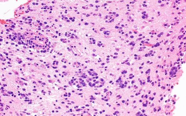 2B2 Lymphoma, B cell (Case 1 -5 years later) area A H&E 5