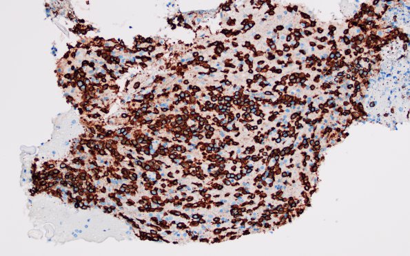 2B3 Lymphoma, B cell (Case 1 -5 years later) area A CD20 20X