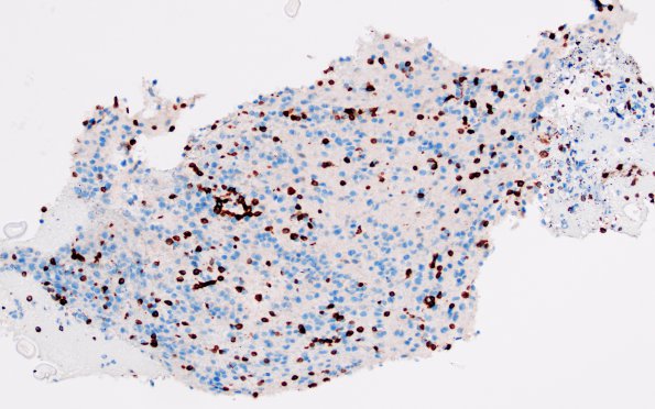 2B4 Lymphoma, B cell (Case 1 -5 years later) area A CD3 20X