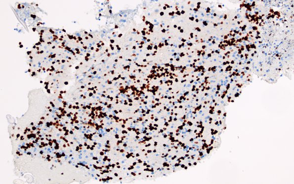 2B5 Lymphoma, B cell (Case 1 -5 years later) area A Ki67 20X