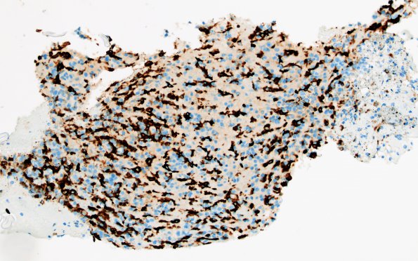 2B6 Lymphoma, B cell (Case 1 -5 years later) area A CD163 1