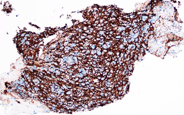 2B7 Lymphoma, B cell (Case 1 -5 years later) area A GFAP 2