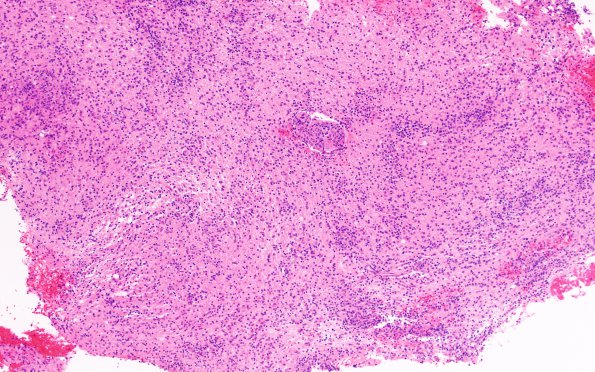 2C1 Lymphoma, B cell (Case 1 -5 years later) area B H&E 10X