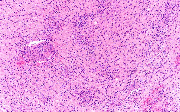 2C2 Lymphoma, B cell (Case 1 -5 years later) area B H&E 20X