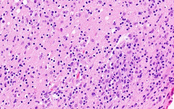 2C3 Lymphoma, B cell (Case 1 -5 years later) H&E 1