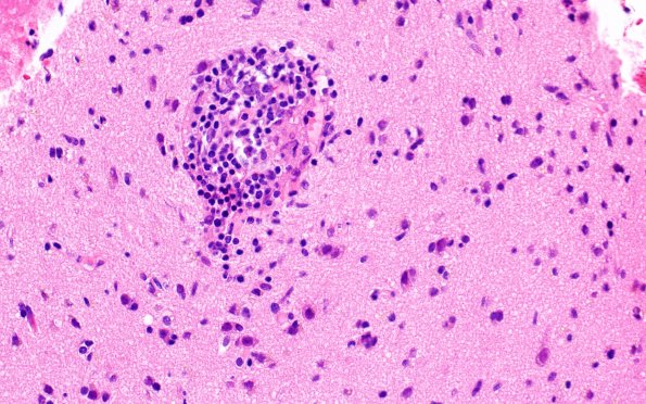 2C4 Lymphoma, B cell (Case 1 -5 years later ) H&E 3