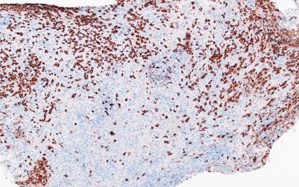 2C5 Lymphoma, B cell (Case 1 -5 years later) area B CD20  1