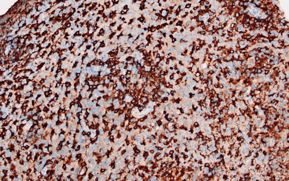 2C7 Lymphoma, B cell (Case 1 -5 years later) area B CD163 1