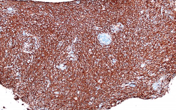 2C8 Lymphoma, B cell (Case 1 -5 years later) area B GFAP  1