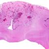 10A1 Lymphoma, intravascular (Case 10) H&E whole mount