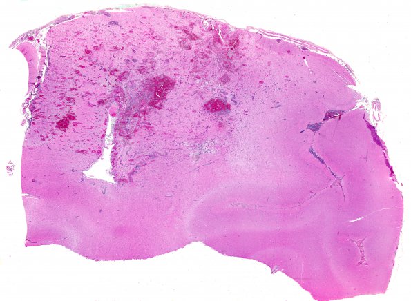 10A1 Lymphoma, intravascular (Case 10) H&E whole mount