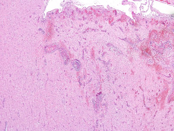 10A2 Lymphoma, Intravascular (Case 10) H&E 21