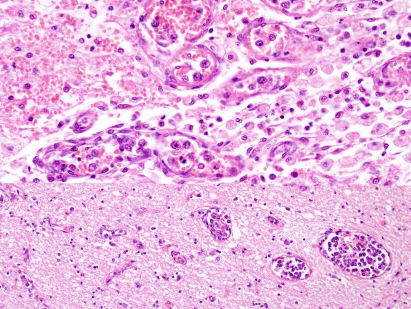 10A3 Lymphoma, Intravascular (Case 10 H&E 4