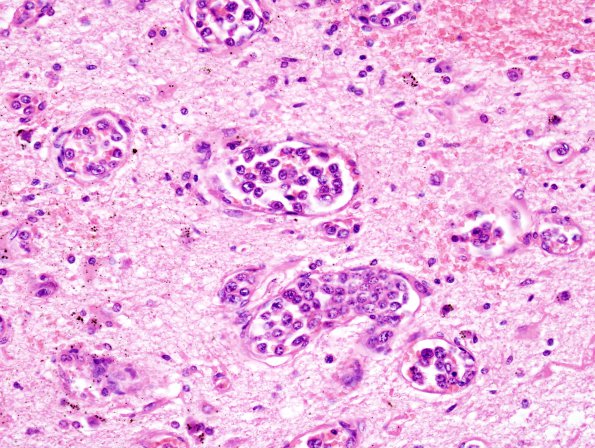 10A4 Lymphoma, Intravascular (Case 10) H&E 8