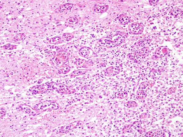 10A5 Lymphoma, Intravascular (Case 10) H&E 3