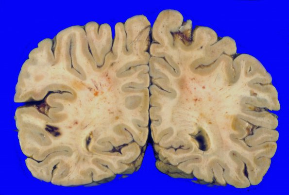 11A3 Lymphoma, intravascular (Case 11) 2