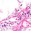 11B2 Lymphoma, intravascular (Case 11) 40X