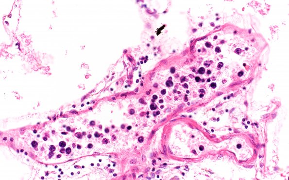 11B2 Lymphoma, intravascular (Case 11) 40X