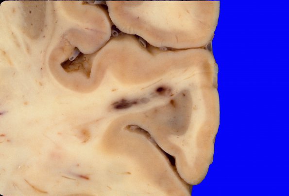 12A3 Lymphoma, intravascular (Case 12) 3