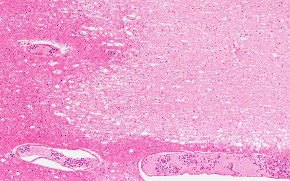 12B1 Lymphoma, intravascular (Case 12) N11 10X 4