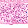 12B2 Lymphoma, intravascular (Case 12) N11 60X 5 copy