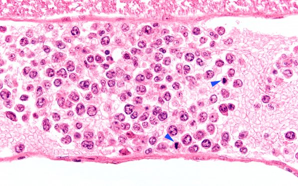 12B2 Lymphoma, intravascular (Case 12) N11 60X 5 copy