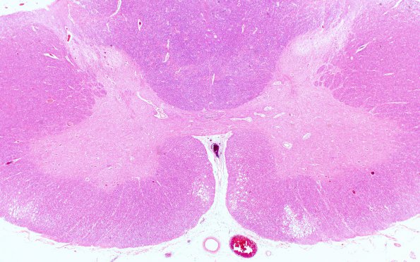 12C1 Lymphoma, intravascular (Case 12) N10 2X