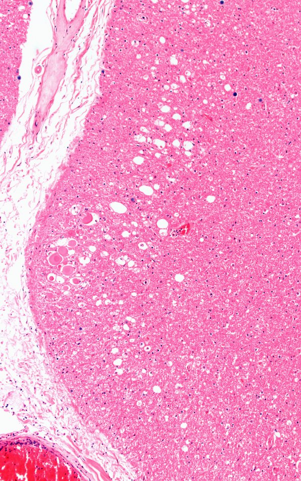 12C2 Lymphoma, intravascular (Case 12) N10 10X