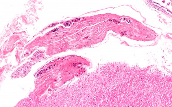 12C3 Lymphoma, intravascular (Case 12) N10 10X 2