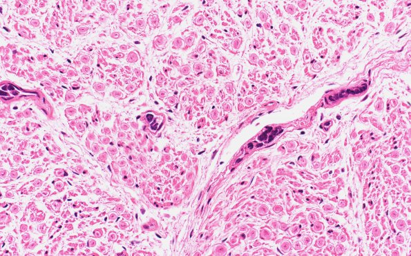 12D1 Lymphoma, intravascular (Case 12) N2A 40X