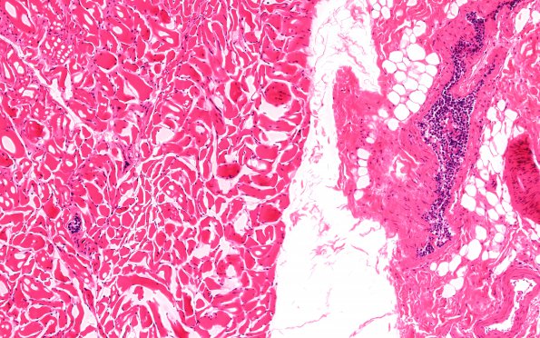 12D2 Lymphoma, intravascular (Case 12) M4 10X