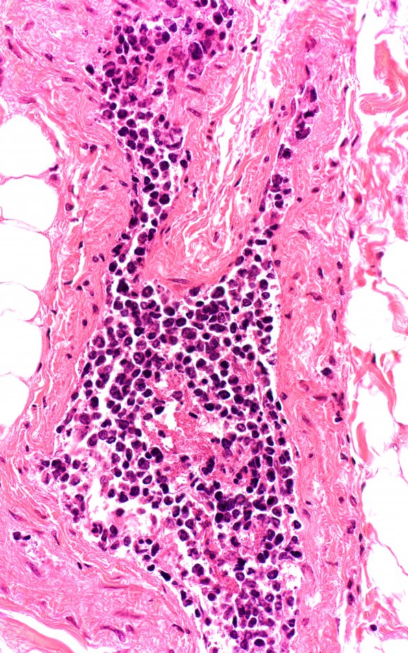 12D3 Lymphoma, intravascular (Case 12) M4 40X 2